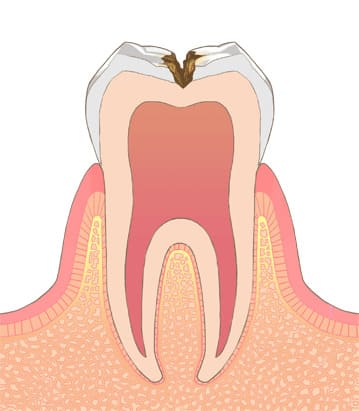 象牙質まで進行した虫歯／C2（シー・ツー）