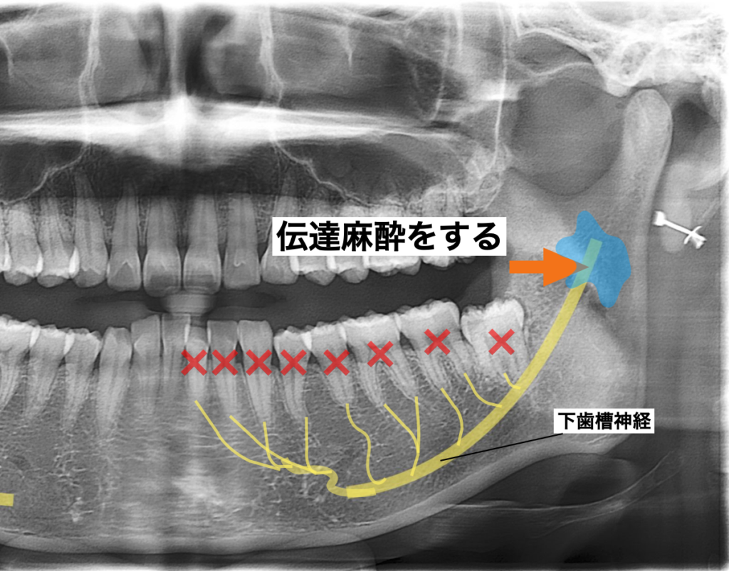 下顎孔伝達麻酔　下歯槽神経　伝麻　道頓堀キムラ歯科クリニック