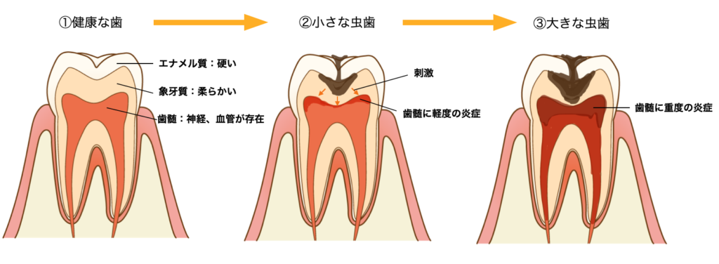 虫歯の進行　急性歯髄炎　道頓堀キムラ歯科クリニック