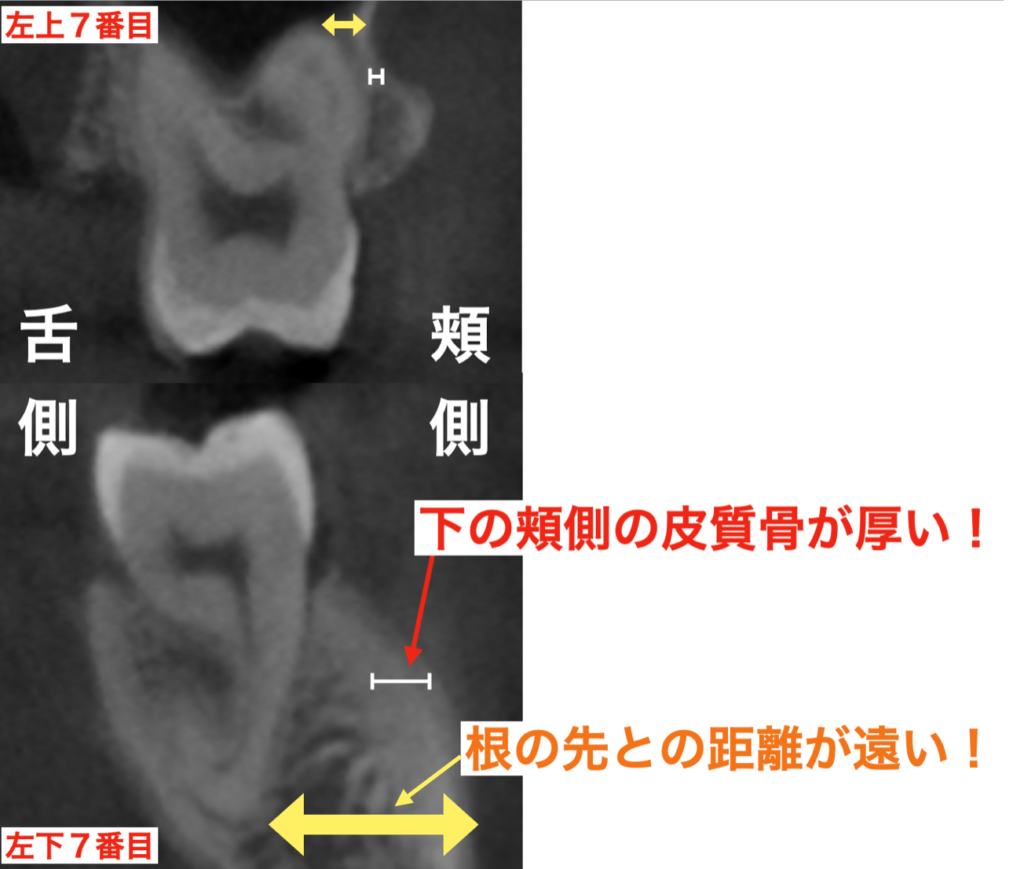 皮質骨と海面骨の厚さ　浸潤麻酔　浸透　道頓堀キムラ歯科クリニック