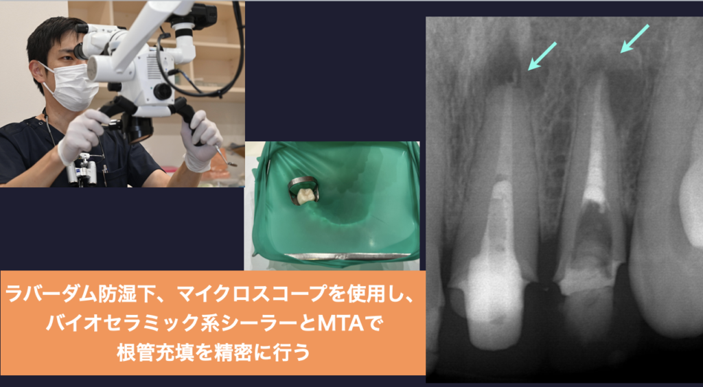 左上１２根尖性歯周炎　マイクロスコープ　ラバーダム防湿　バイオセラミック系シーラー　MTA根管充填　歯根端切除