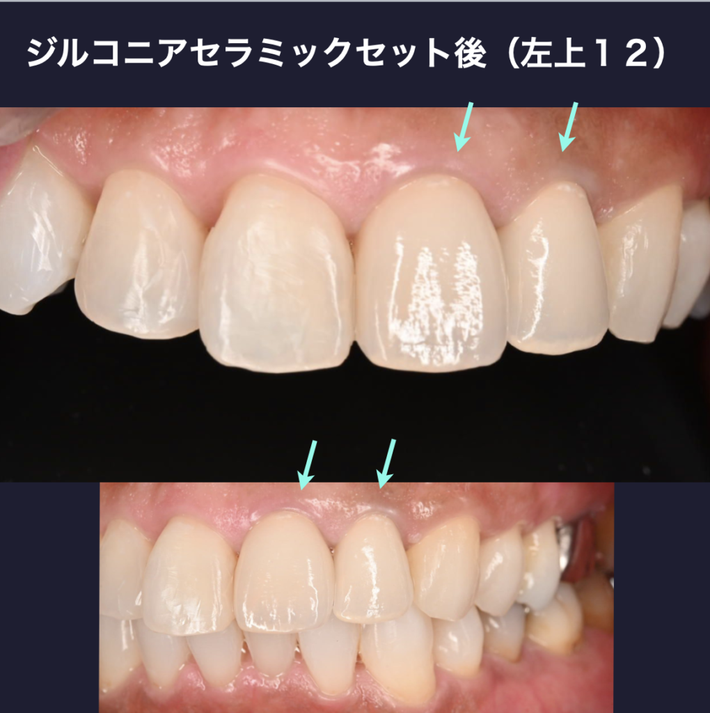 左上１２　ジルコニアセラミッククラウン　審美歯科　セラミック治療
