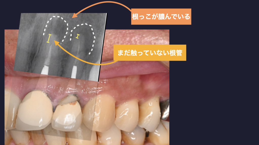 左上１２　根尖性歯周炎　マイクロスコープ　精密根管治療　