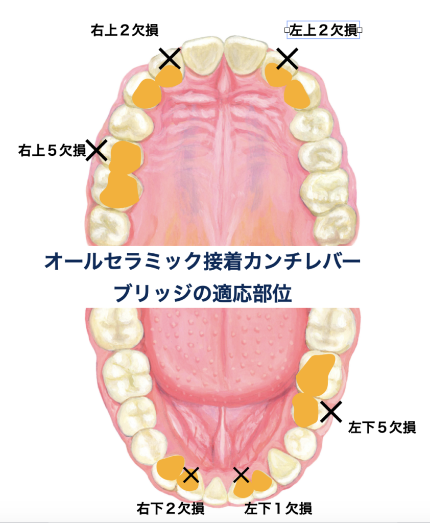 オールセラミック接着管理レバーブリッジ　適応部位　上顎側切歯欠損　下顎中切歯欠損　側切歯欠損　上下顎第二小臼歯欠損