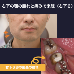 右下顎　腫れ　腫脹　右下６急性化膿性根尖性歯周炎（Acute Apical Abscess）、頬部膿瘍
