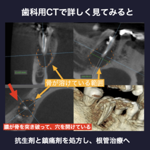 CT 右下６急性根尖性化膿性歯周炎　パーフォレーション　マイクロスコープ　