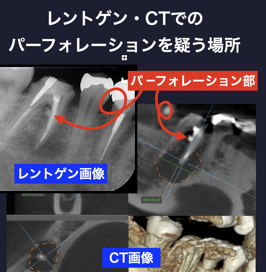 レントゲン・CTでのパーフォレーションを疑う画像
