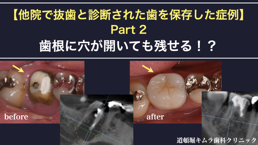 【他院で抜歯と診断された歯を保存した症例】　Part2  歯根に穴が空いても残せる！？パーフォレーションリペア（穿孔封鎖）で治らない時の最終手段