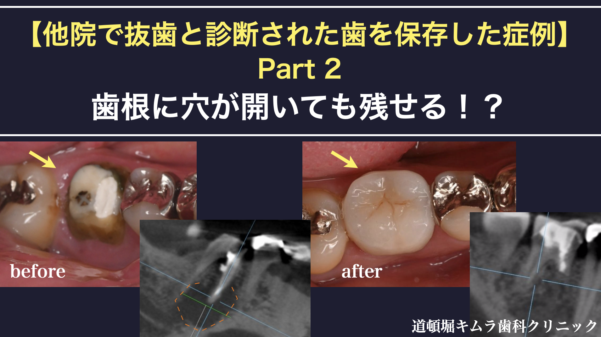 きがるな根管処置法   PARTー2 きがるな根管処置法 PARTー2