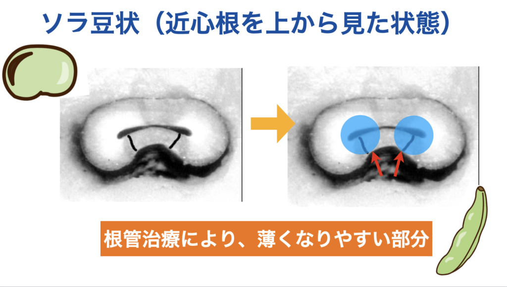 ストリップパーフォレーション　根管治療　大臼歯　近心根遠心壁　そら豆