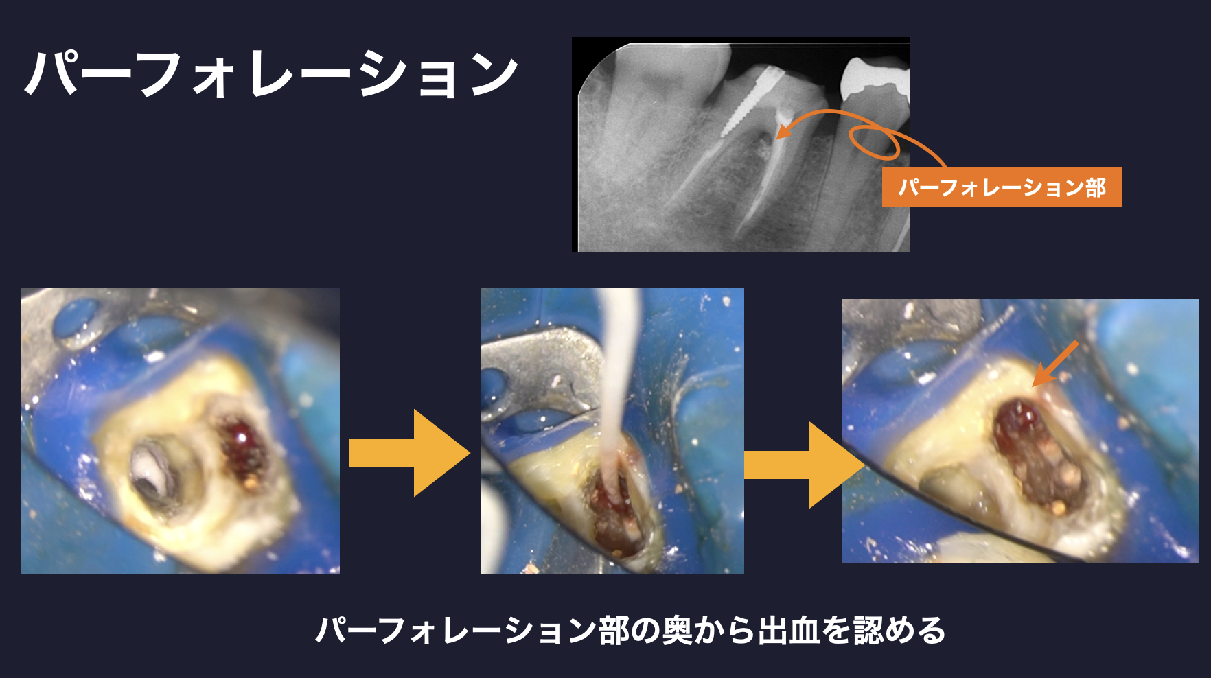 歯根　パーフォレーション　出血
