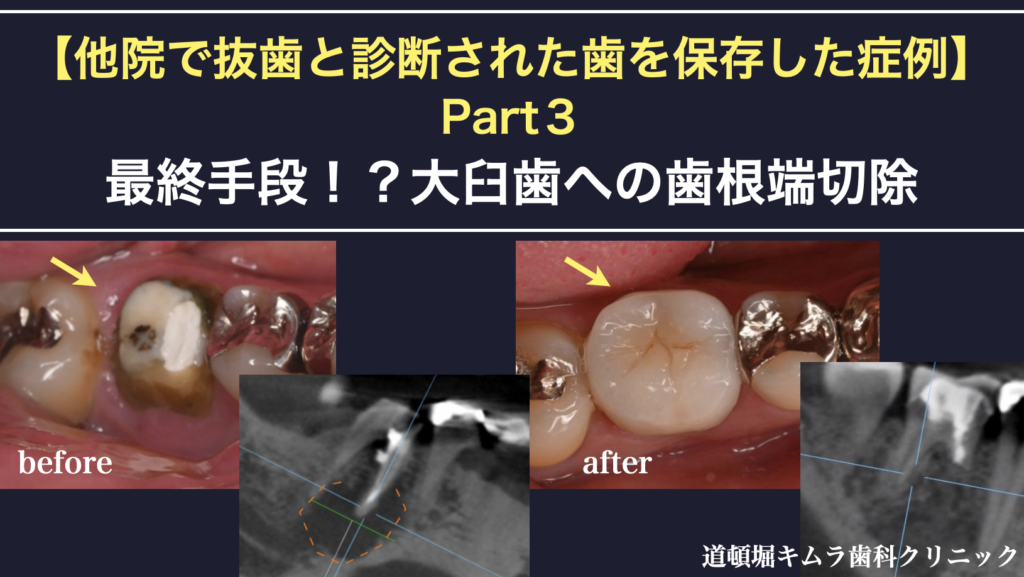 大臼歯への歯根端切除　他院で抜歯と診断された歯を保存した症例　　パーフォレーションリペア