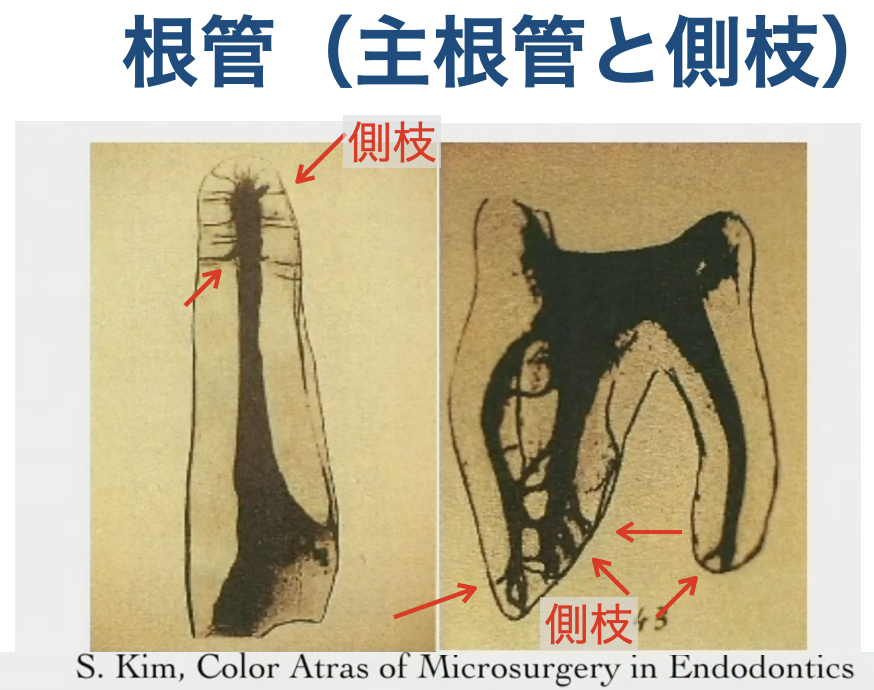 主根管と側枝　マイクロスコープ　精密根管治療　歯根端切除術　意図的再植術　外科的歯内療法　マイクロエンドサージェリー