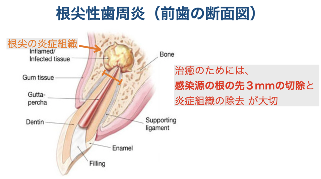 根尖性歯周炎　歯根端切除　