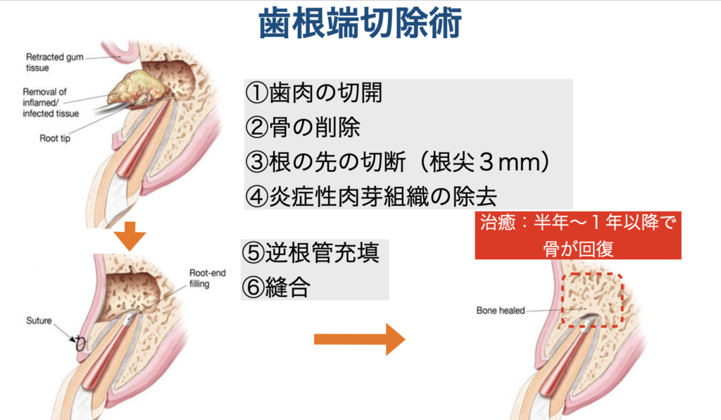 歯根端切除術（Apicoectomy）　マイクロエンドサージェリー　外科的歯内療法　マイクロスコープ