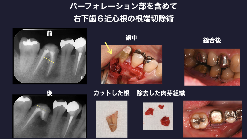 パーフォレーション　ストリップパーフォレーション
右下歯６　近心根　歯根端切除術　マイクロエンドサージェリー　マイクロスコープ
