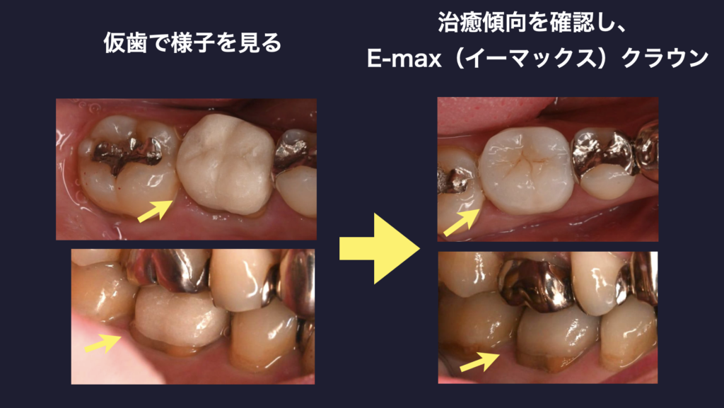 大臼歯　歯根端切除術　マイクロスコープ　マイクロエンドサージェリー　セラミッククラウン　E-max（イーマックス）クラウン