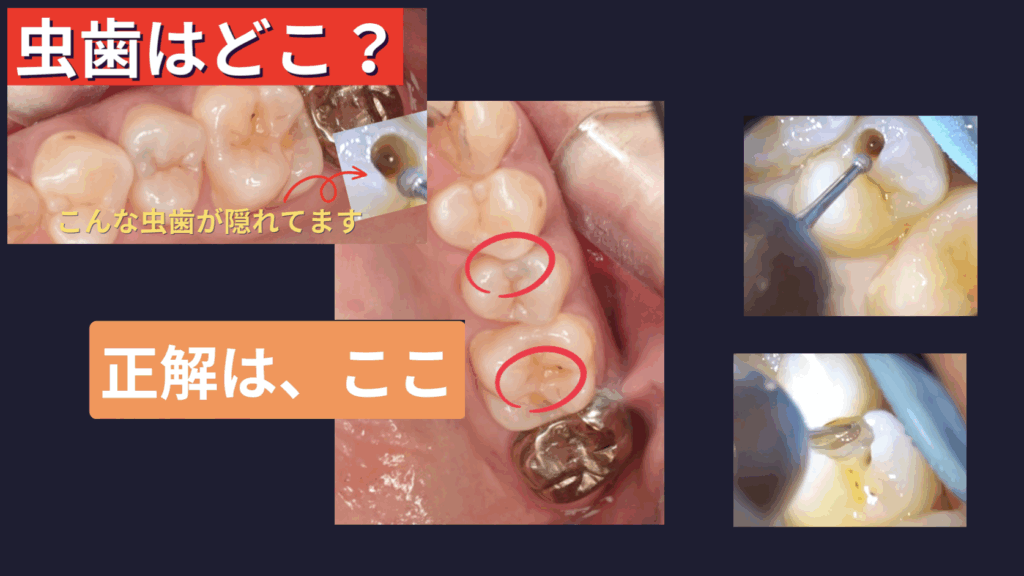 初期虫歯 虫歯 早期発見 マイクロスコープ