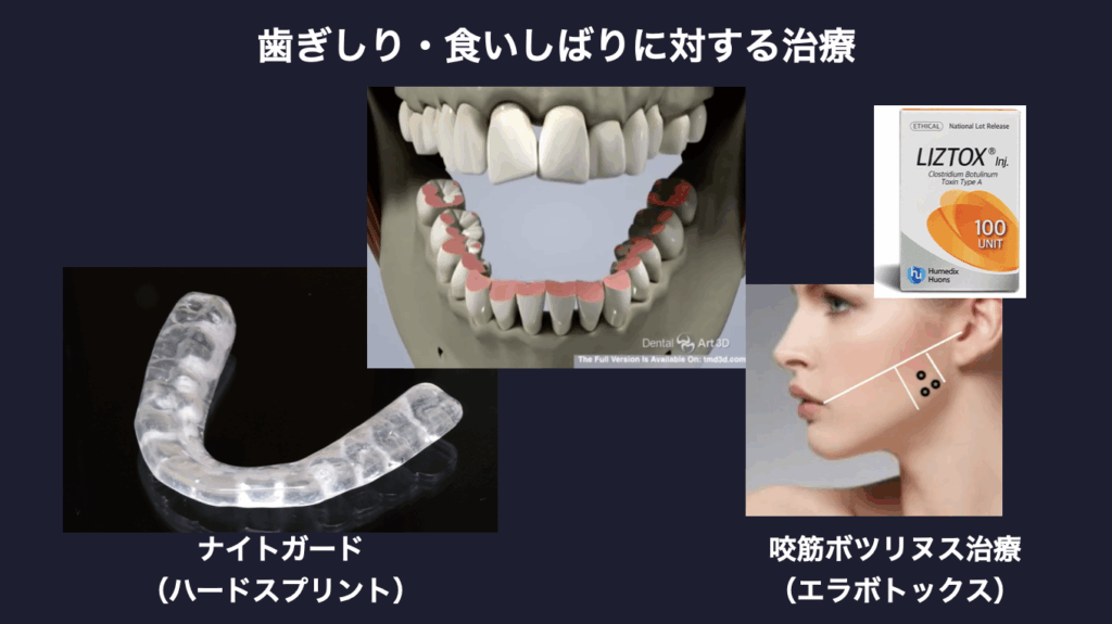 歯ぎしり 食いしばり 治療 ナイトガード ハードスプリント 咬筋ボツリヌス治療 エラボトックス