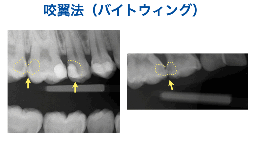 咬翼法　バイトウィング
レントゲン写真
虫歯　早期発見