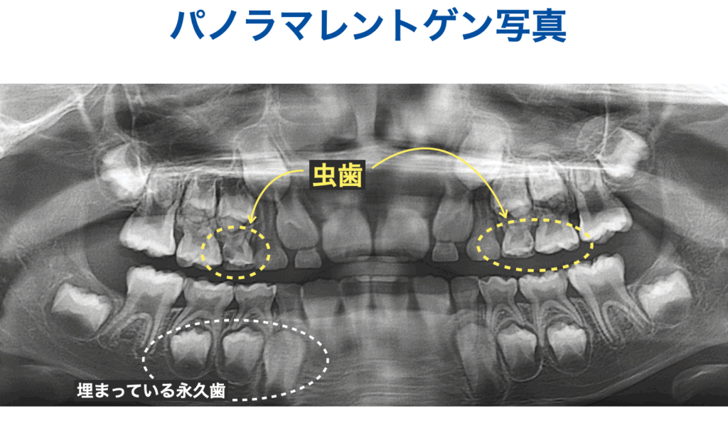 パノラマレントゲン写真
後継永久歯
虫歯
発見