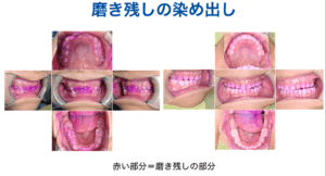 ブラッシング指導
磨き残し
染め出し