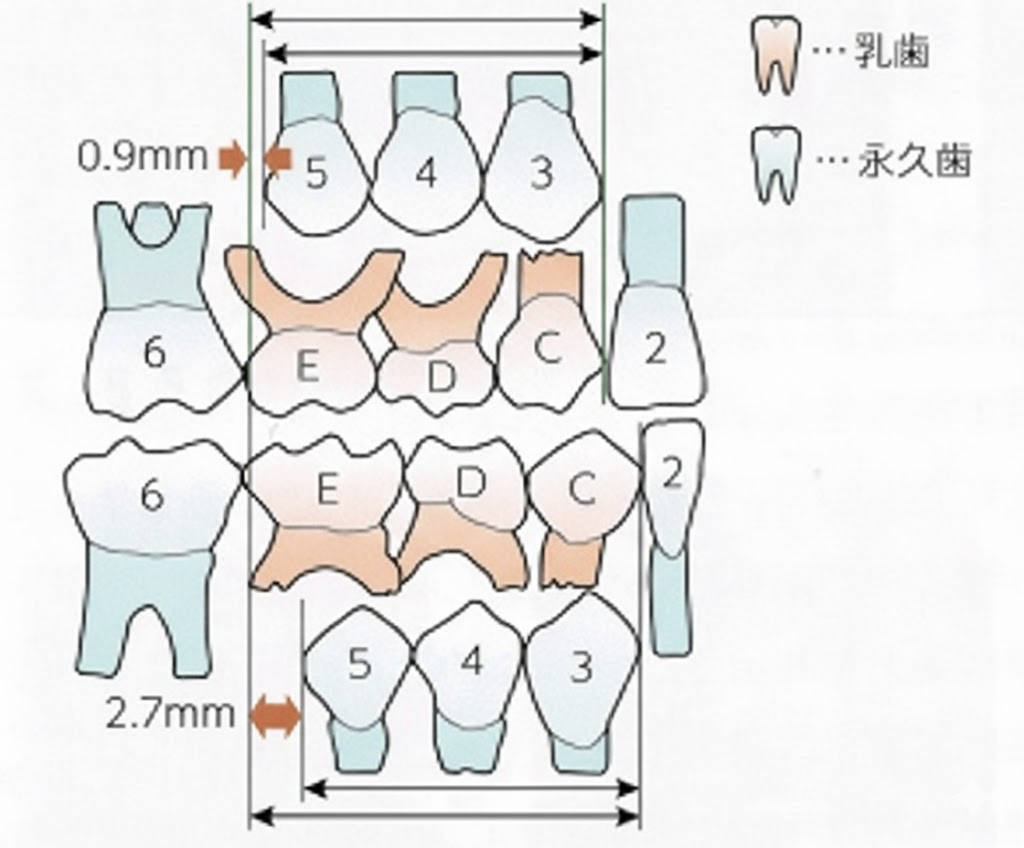 リーウェイスペース　小児矯正
リンガルアーチ　一期治療　床矯正
