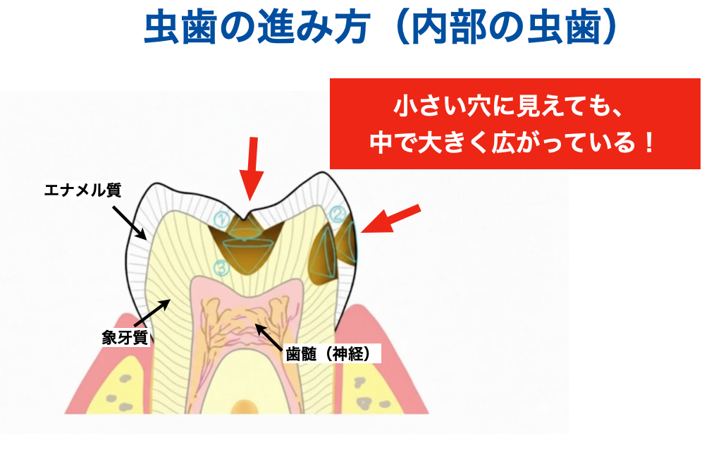 虫歯の進み方　C２
子供の虫歯
隣接面カリエス
小窩裂溝う蝕