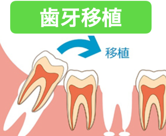 歯牙移植
